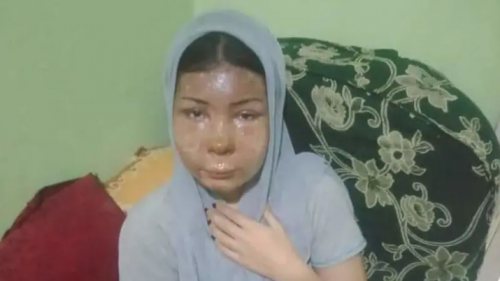 صور صادمة .. مأساة شابة  رفضت الزواج من شاب فصب مياه نار على وجهها